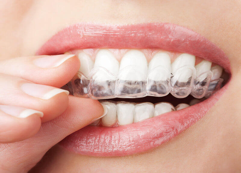 How Invisalign Aligner Trimlines Affect Gum Health and Soft Tissue Comfort During Orthodontic Treatment
